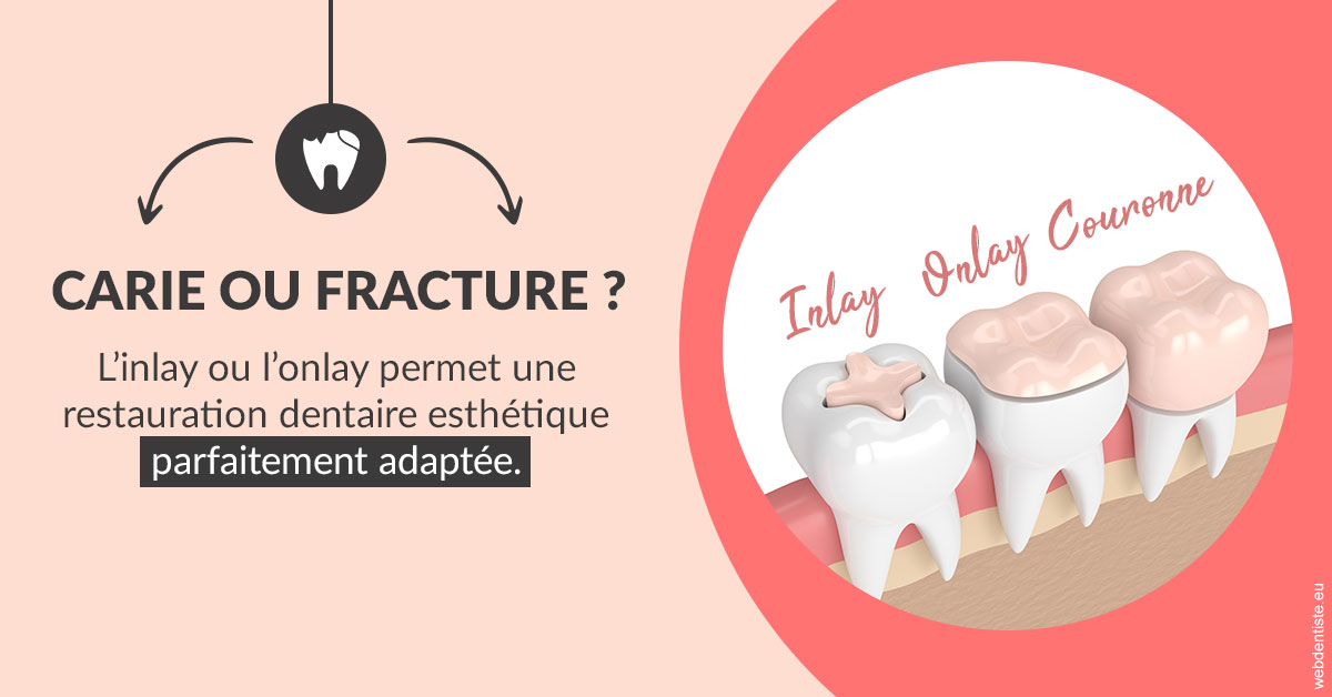 https://dr-zenou-stephane.chirurgiens-dentistes.fr/T2 2023 - Carie ou fracture 2