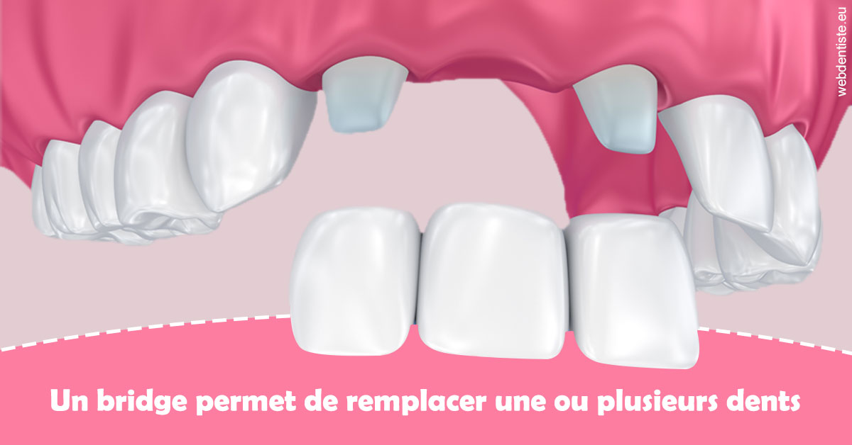 https://dr-zenou-stephane.chirurgiens-dentistes.fr/Bridge remplacer dents 2