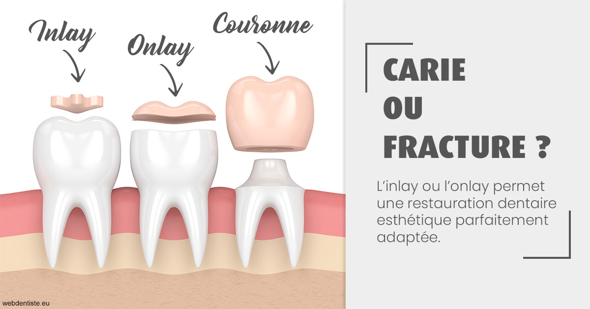 https://dr-zenou-stephane.chirurgiens-dentistes.fr/T2 2023 - Carie ou fracture 1