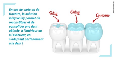 https://dr-zenou-stephane.chirurgiens-dentistes.fr/L'INLAY ou l'ONLAY