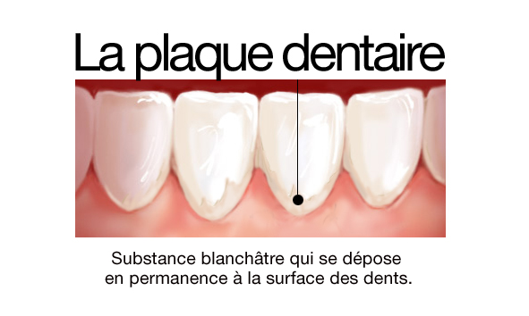 La-plaque-dentaire2