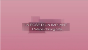 La pose d'un implant
